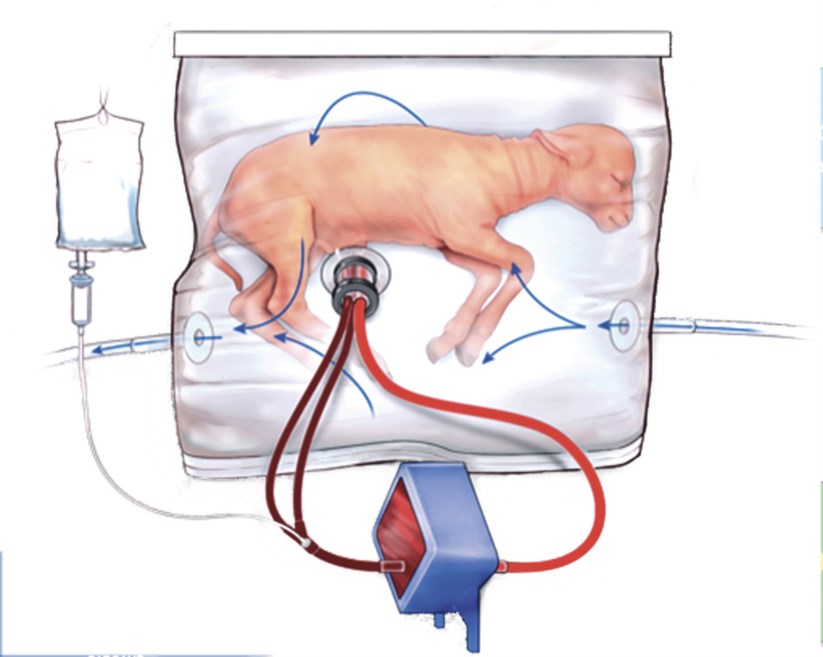 Sistema consiste num saco de polietileno (plástico), cheio com fluido e que incorpora um circuito de oxigénio através de uma interface de cordão umbilical, que imita o ambiente intra-uterino